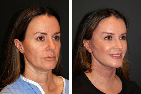 best-facelift-at-forty-before-after